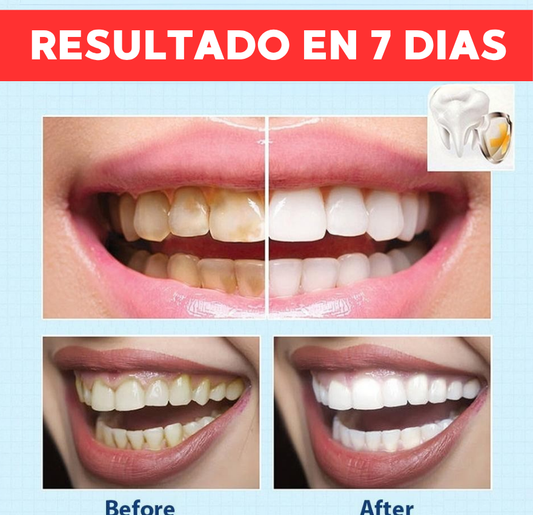 LAPIZ BLANQUEADOR DENTAL| EXPRESS 🦷
